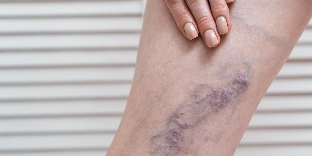 How Vein Disease Can Impact Your Life