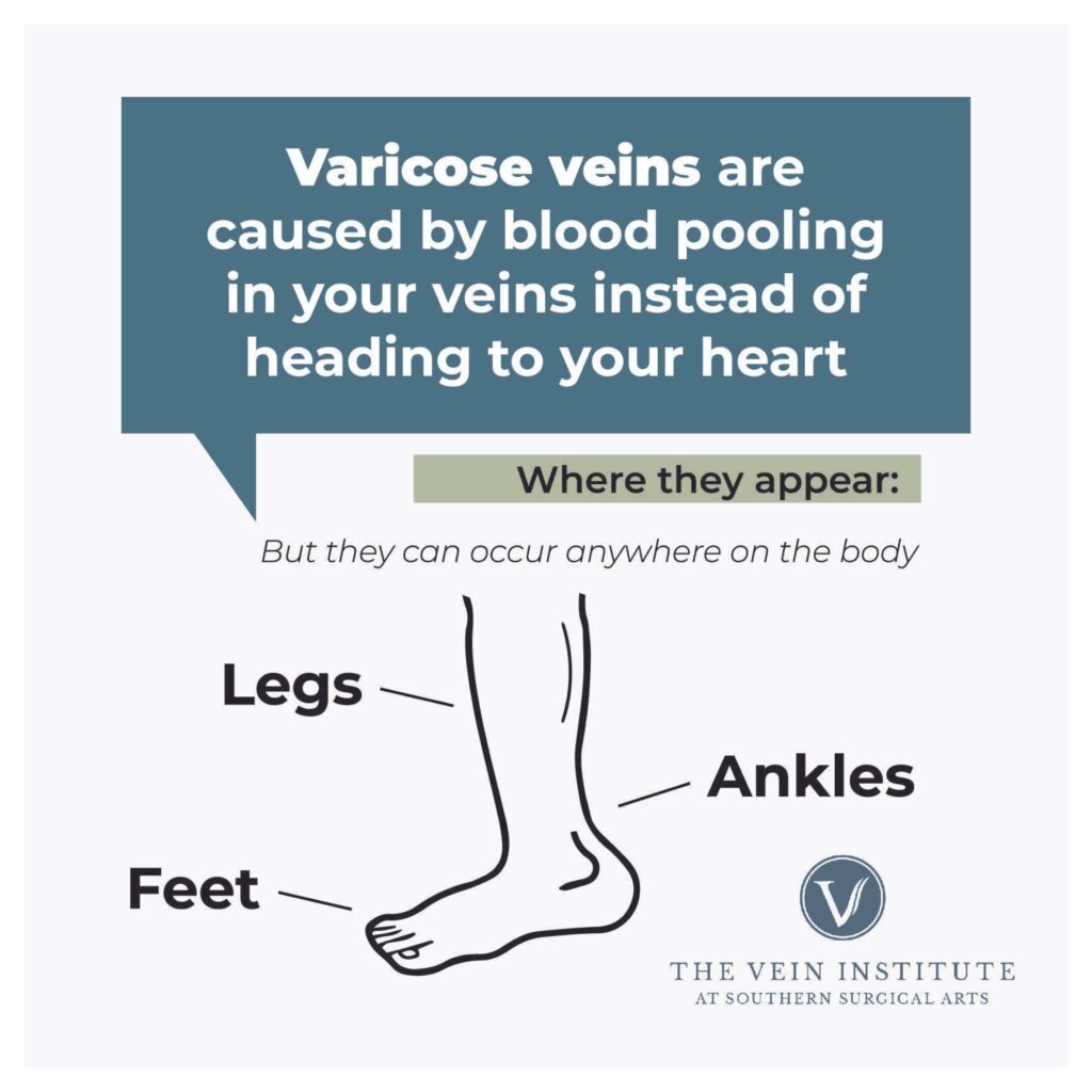 Varicose Veins Infographic
