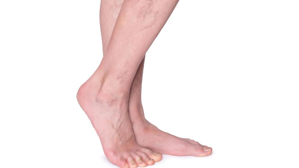 What Your Spider Veins May Be Saying to You