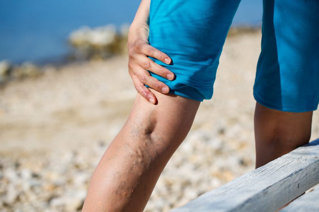 Who's at Risk for Varicose Veins